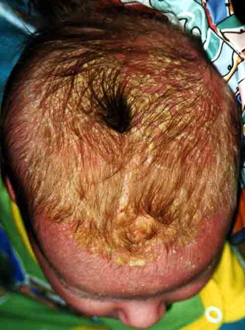 Photo of baby cradle cap in infant